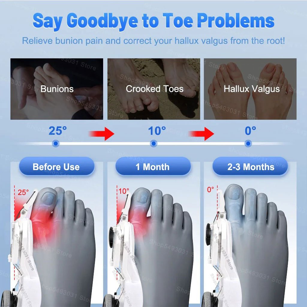 Correcteur Hallux Valgus avec Molette Réglable– Soulagement et Alignement Progressif image 5